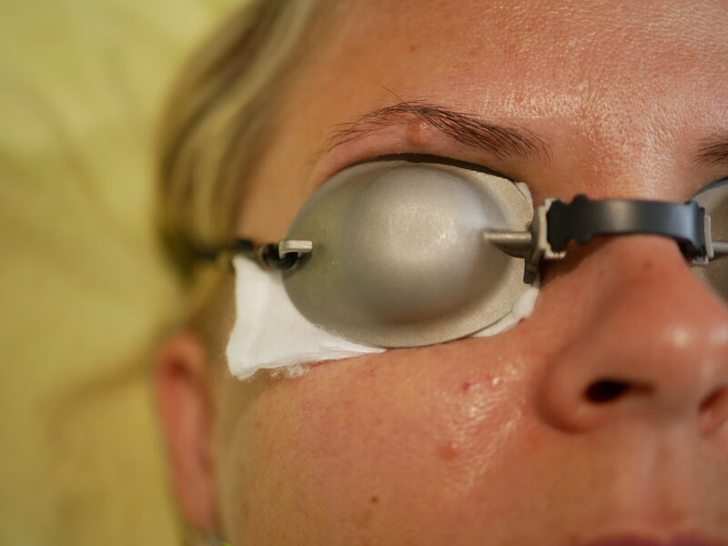 Cosmetic Laser