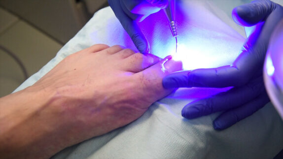 Laser ingrown Toe nails