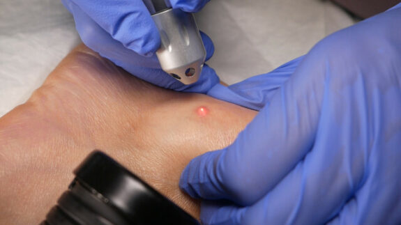 laser treat skin tag foot